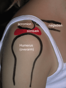 Shoulder impingement syndrome